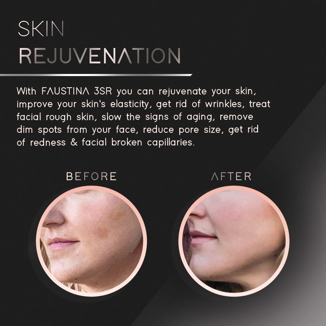 FAUSTINA Skin Rejuvenation IPL (1,500,000 Shots) USA & UK Plug Adapters | Free Pouch & Sunglasses.
